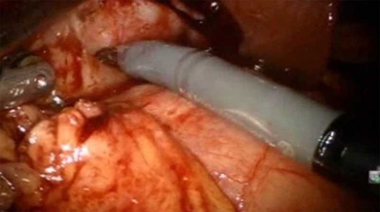 Cholecystectomy