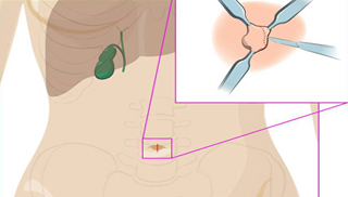 Single Incision Robotic Cholecystectomy Surgery by Dr. Iraniha